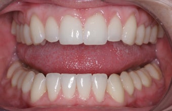 Invisalign