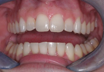 Invisalign
