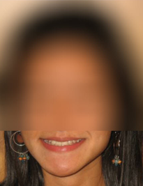 Invisalign