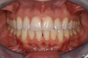 Invisalign