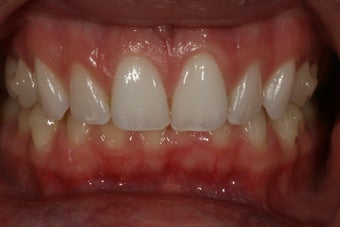 Invisalign