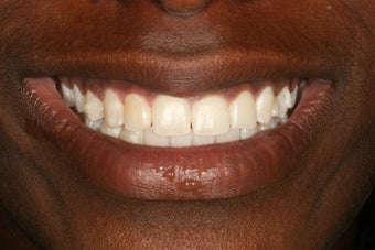 Invisalign