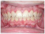 Deep Overbite Correction