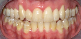 Invisalign