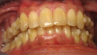 Invisalign Treatment 