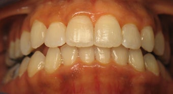Invisalign performed 