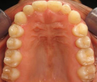 Invisalign 