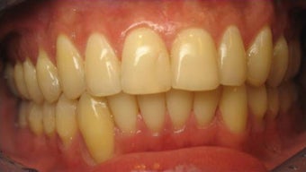 Invisalign 