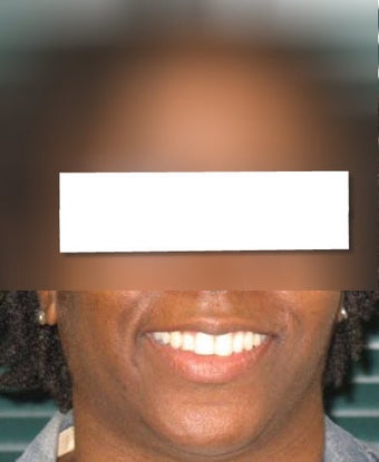 Invisalign