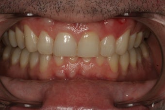 Invisalign Treatment