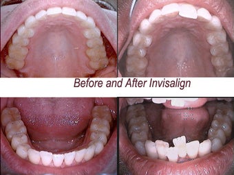 Invisalign