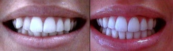 Invisalign