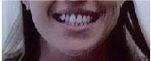 Invisalign