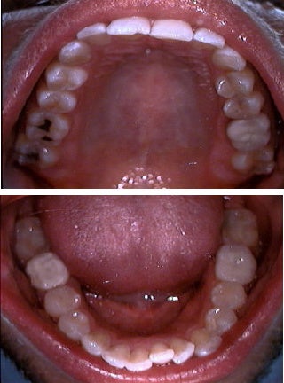 Invisalign