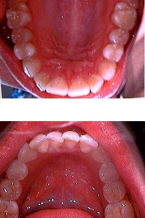 Invisalign