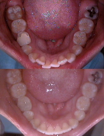 Invisalign