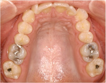 Pre Prosthetic Invisalign