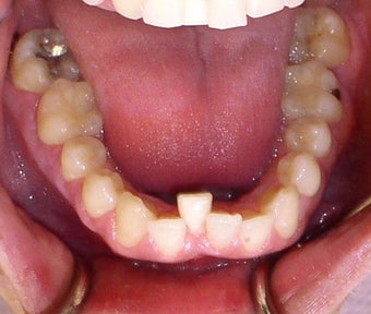 Invisalign
