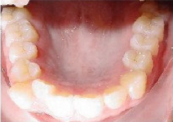 Invisalign Treatment