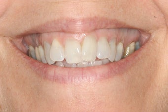 Invisalign and Whitening