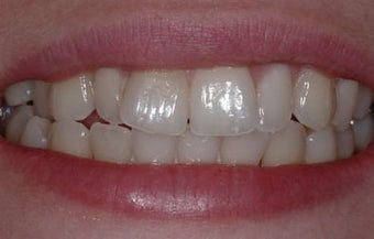 INVISALIGN