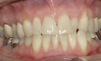 Invisalign correction of crowding