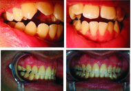 Invisalign 