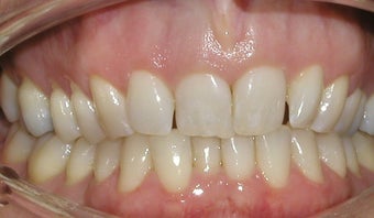 Invisalign used to correct flaring and overlapping teeth