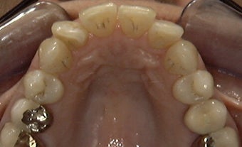 Invisalign: dramatic rotation of front teeth