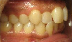 Invisalign Treatment