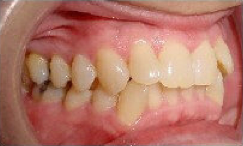 Invisalign Treatment
