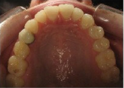 Invisalign Treatment