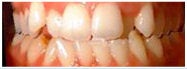 Invisalign to fix Crowded Teeth