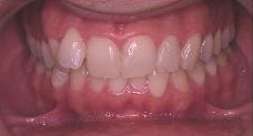 Invisalign