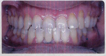 Anterior Crossbite