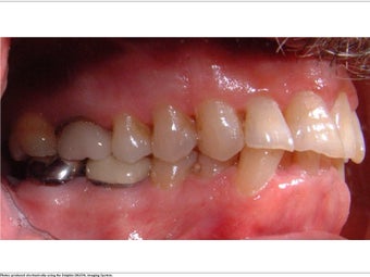 Invisalign