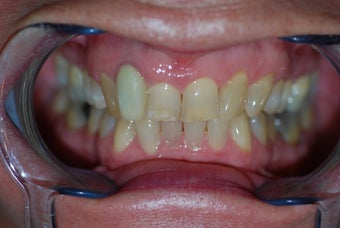 Invisalign to replace a HIDEOUS crown/tooth