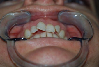 Moderate anterior crowding treated with Invisalign