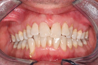 Invisalign 
