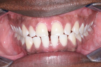 Invisalign