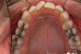 Invisalign