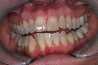Invisalign
