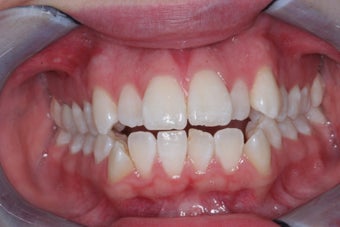 Invisalign