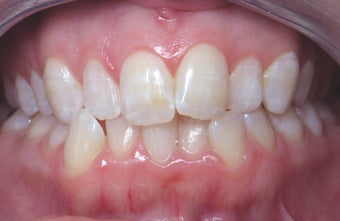 Invisalign