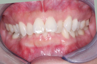 Invisalign