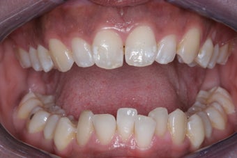 Invisalign