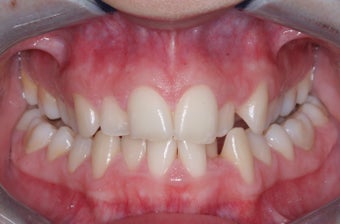Invisalign