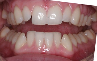 Invisalign