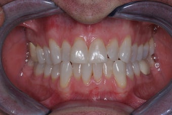 Invisalign
