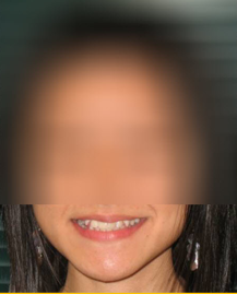 Invisalign